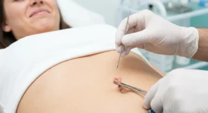 Piercer w rękawiczkach chwyta szczypcami skórę nad pępkiem i przygotowuje igłę do przekłucia.